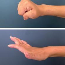 Efectos de la terapia