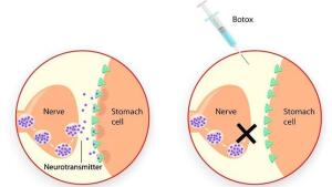 El bótox podría ser eficaz para combatir el cáncer de estómago