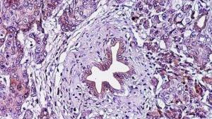 Infectar a las células tumorales de gripe podría ser la clave para vencer al cáncer de páncreas