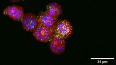 Diseñado un tratamiento con nanopartículas eficaz frente al cáncer de endometrio más letal