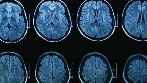 Parkinson: avances en investigación y retos futuros